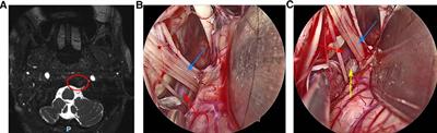 Case report: Fully endoscopic microvascular decompression for glossopharyngeal neuralgia